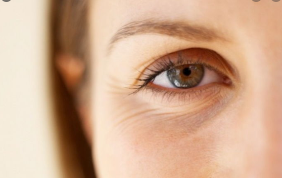 Göz altı kırışıkları tedavisi